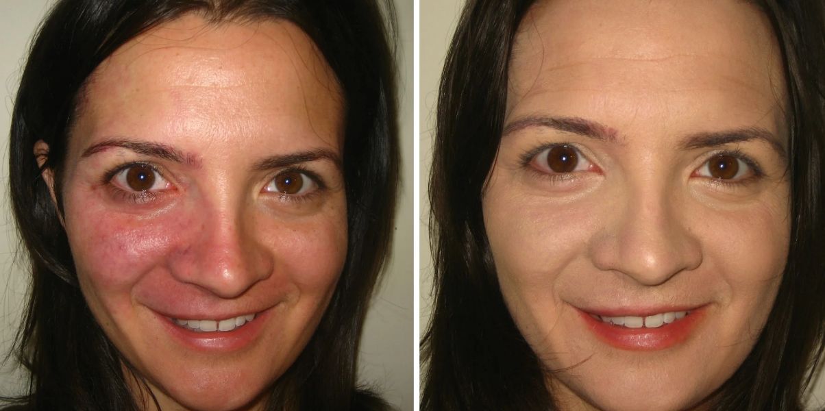Before &After